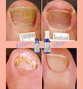 Cheese-like smell coming from toenails? Eliminate it!